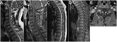 Case report: A choroidal fissure pial arteriovenous malformation inducing venous congestive edema of the medulla oblongata and cervicothoracic spinal cord presented with proximal arm predominant weakness